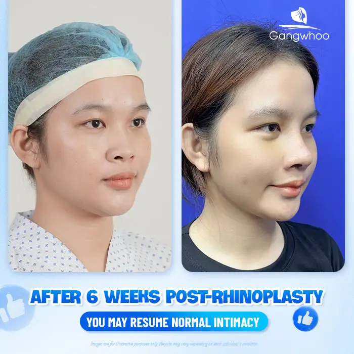 Is it allowed to have sexual intercourse after rhinoplasty? Is abstinence required?