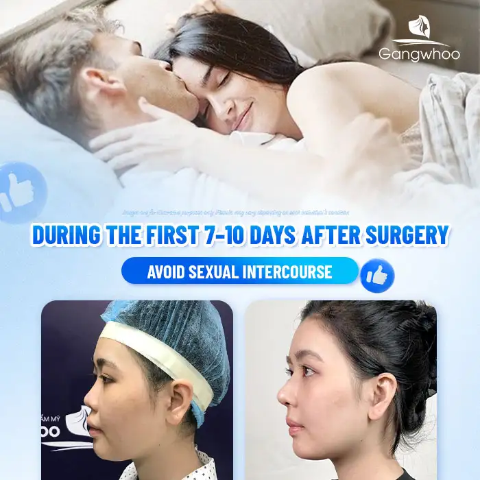 Is it allowed to have sexual intercourse after rhinoplasty? Is abstinence required?