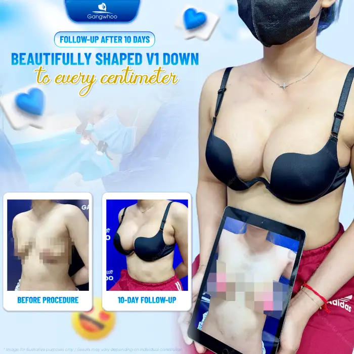 What non-surgical breast augmentation methods are available today?