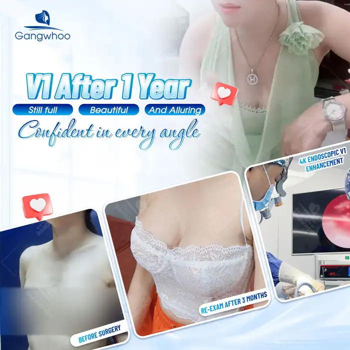 Should You Choose Nano Chip Breast Implants? Advantages and Disadvantages