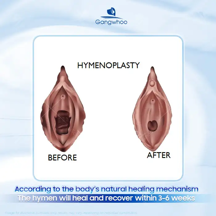 How long does hymen repair take to heal? Post-procedure care notes