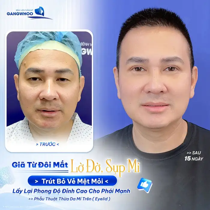 Cắt Mí Mắt Vi Phẫu Là Gì? Giải Pháp Tạo Mí An Toàn, Chuẩn Y Khoa 8 Cắt Mí Mắt Vi Phẫu Là Gì? Giải Pháp Tạo Mí An Toàn, Chuẩn Y Khoa