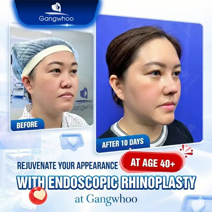Is Synthetic Cartilage Rhinoplasty Permanent? Long-Term Maintenance Care