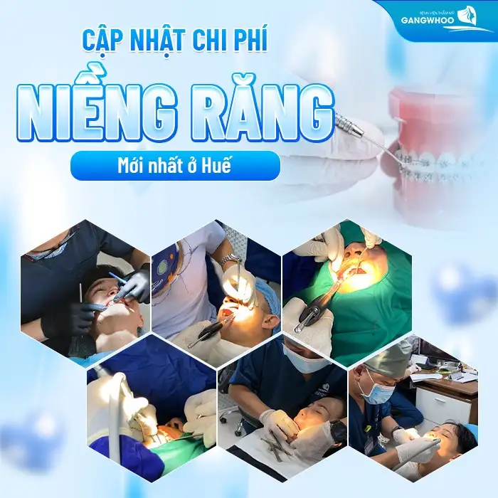 Cập nhật chi phí niềng răng mới nhất ở Huế