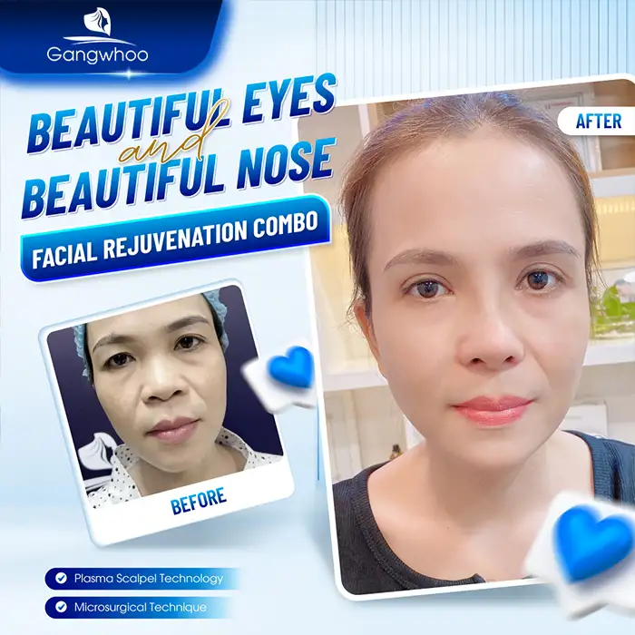 How long does eyelid surgery swelling last? What are effective ways to reduce swelling?