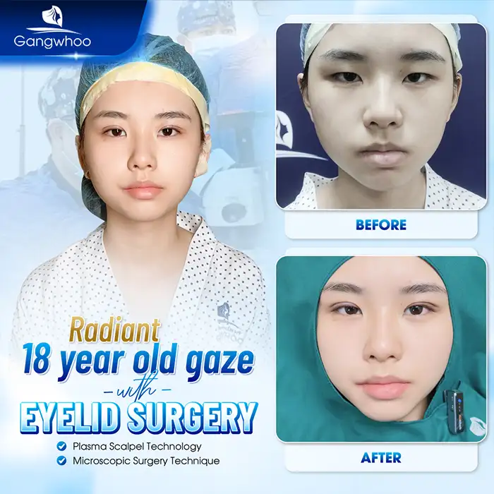 How long does eyelid surgery take to heal and look beautiful? What is the recovery timeline?