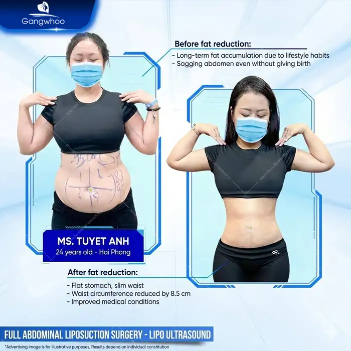 Who are the best abdominal liposuction surgeons in Ho Chi Minh City? Top 5+ reputable doctors