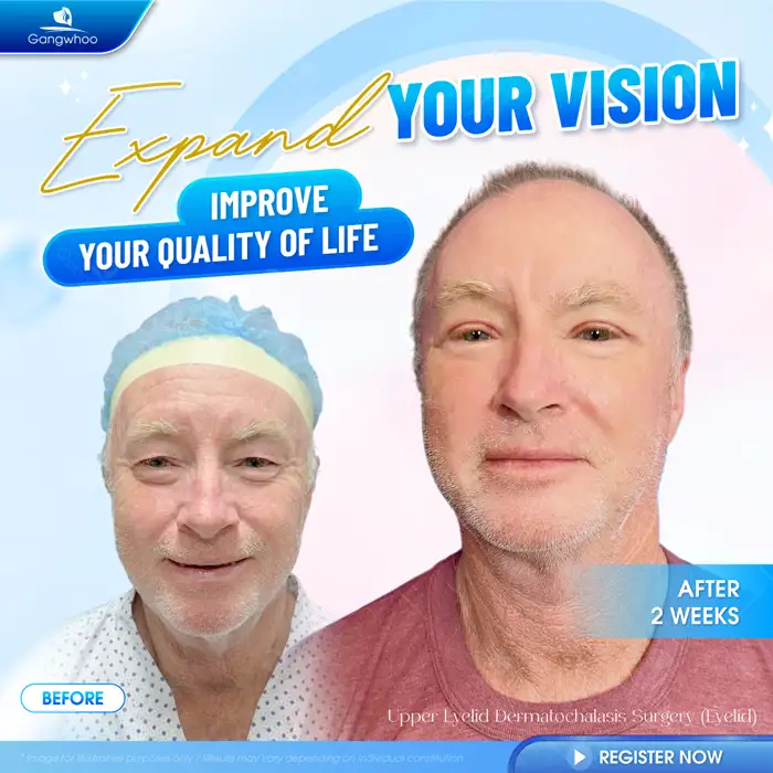 Revealing the Top High-Tech Double Eyelid Surgery Methods Today 4 Revealing the Top High-Tech Double Eyelid Surgery Methods Today