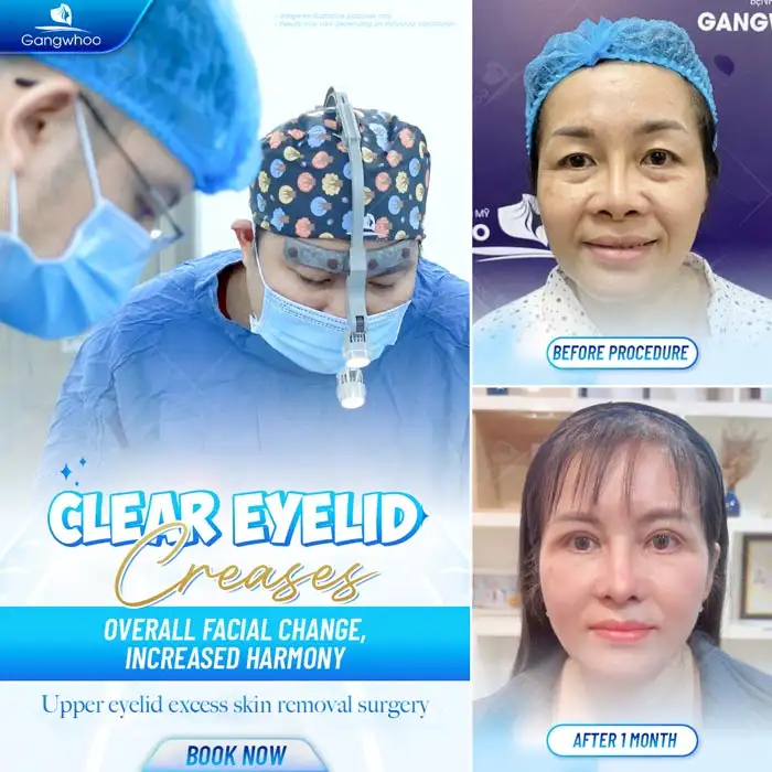 Revealing the Top High-Tech Double Eyelid Surgery Methods Today 5 Revealing the Top High-Tech Double Eyelid Surgery Methods Today