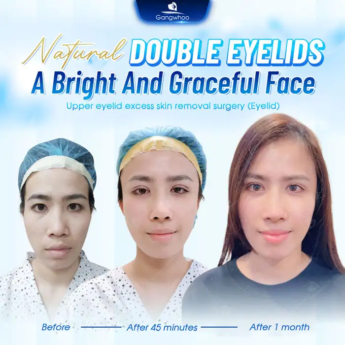 Revealing the Top High-Tech Double Eyelid Surgery Methods Today 2 Revealing the Top High-Tech Double Eyelid Surgery Methods Today