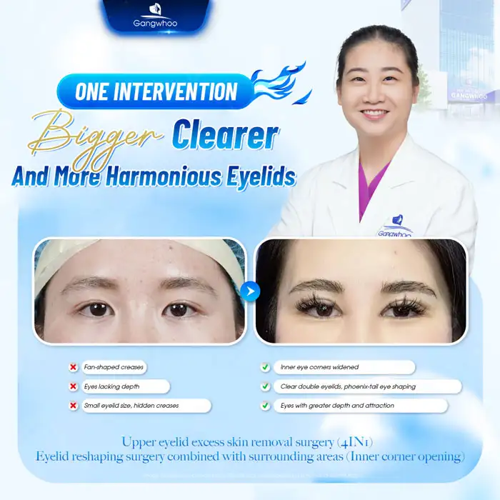 Revealing the Top High-Tech Double Eyelid Surgery Methods Today 3 Revealing the Top High-Tech Double Eyelid Surgery Methods Today