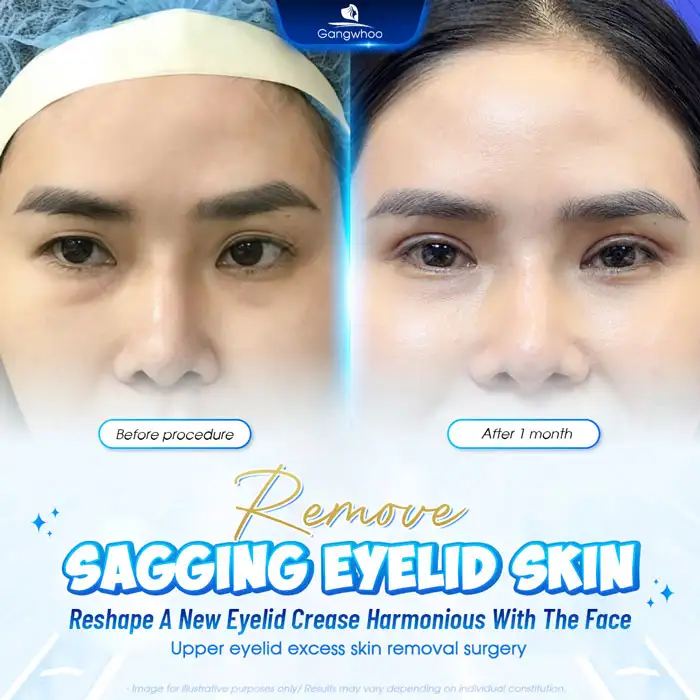 Revealing the Top High-Tech Double Eyelid Surgery Methods Today 1 Revealing the Top High-Tech Double Eyelid Surgery Methods Today