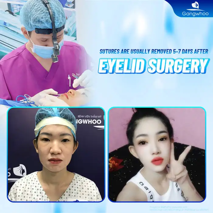 How is medically standard eyelid suture removal performed? How to care for the eyelids after suture removal