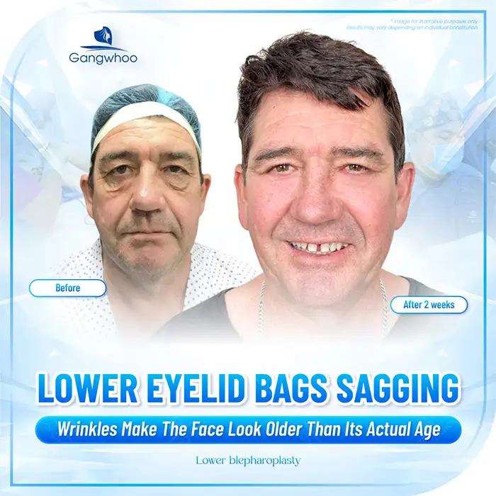 Lower Eyelid Excess Skin Removal Cost? Updated Latest Double Eyelid Surgery Price List 2025
