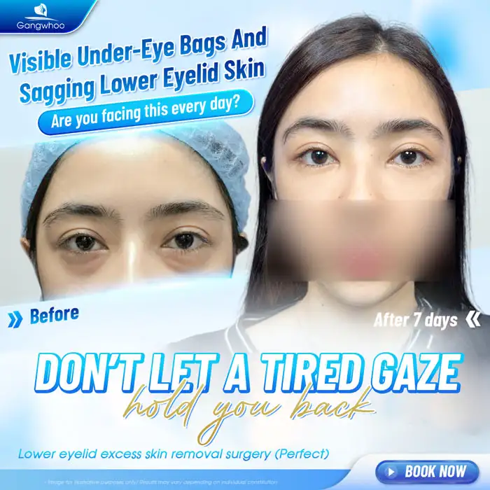 Lower Eyelid Excess Skin Removal Cost? Updated Latest Double Eyelid Surgery Price List 2025