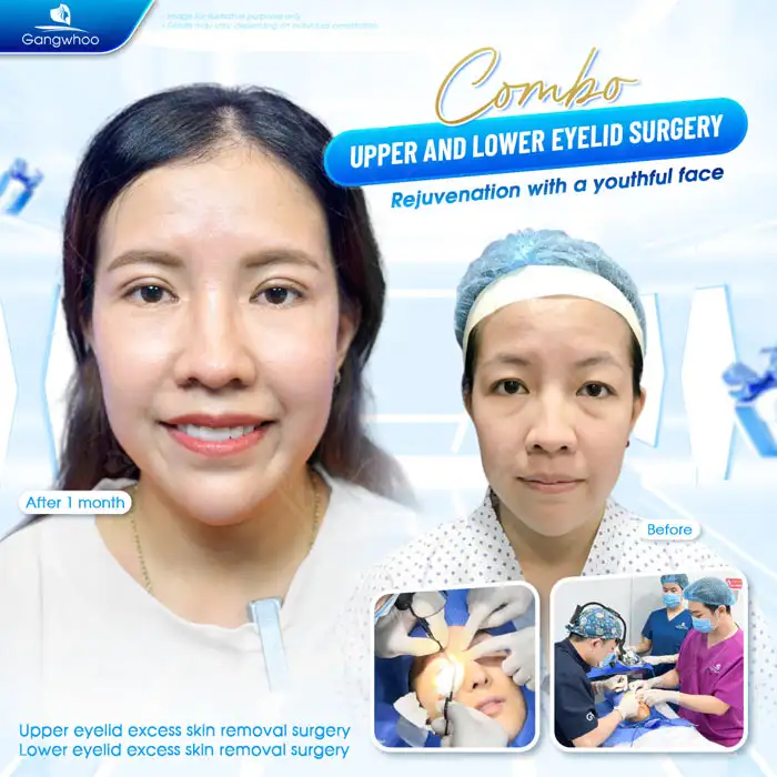 Lower Eyelid Excess Skin Removal Cost? Updated Latest Double Eyelid Surgery Price List 2025