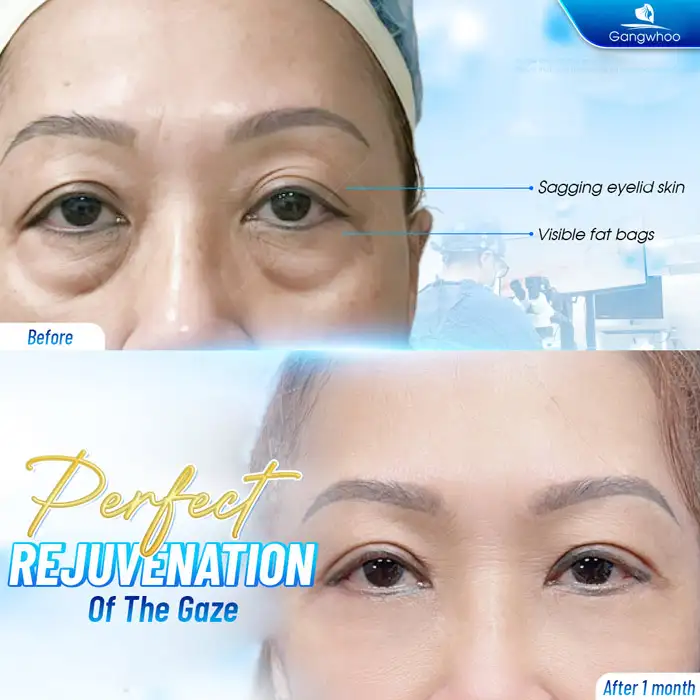 How much does ptosis eyelid surgery cost? Updated latest price list 2026