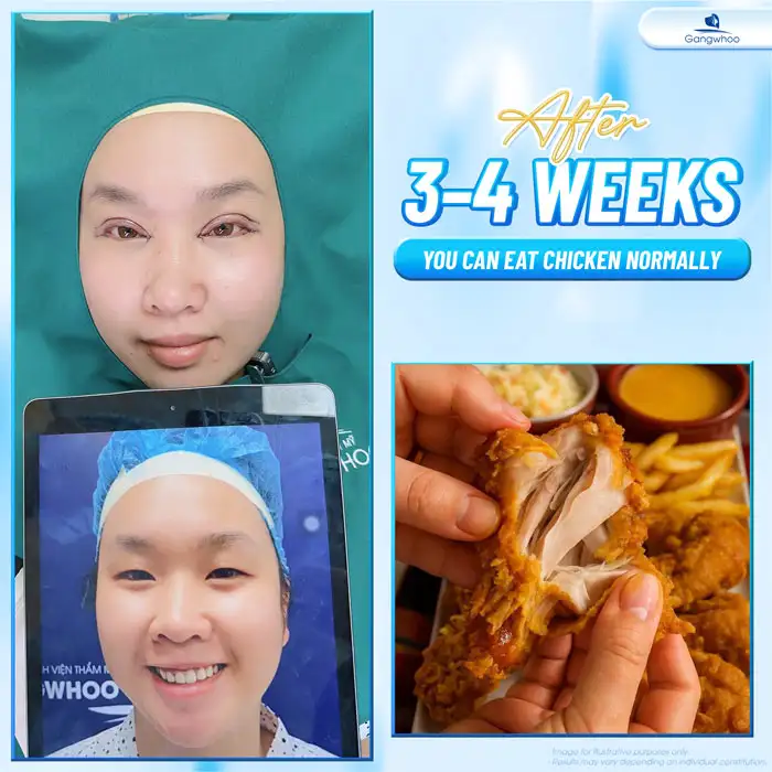 How long after double eyelid surgery can you eat chicken to avoid swelling