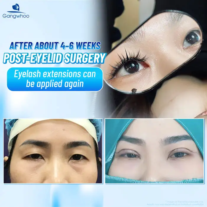 How Long After Eyelid Surgery Can You Get Eyelash Extensions? Important Notes for Eyelash Extensions After Eyelid Surgery