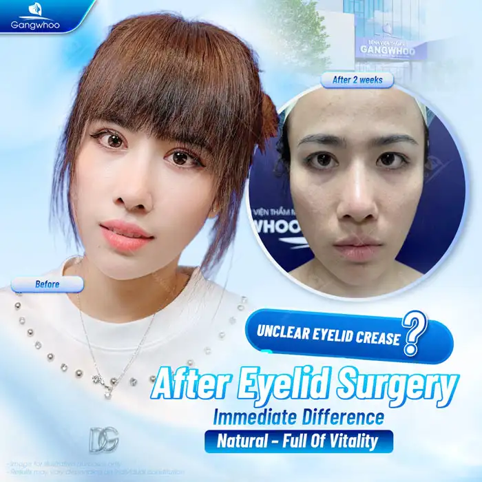 How long does it take for scars to fade after eyelid surgery? Ways to help scars fade faster after eyelid surgery