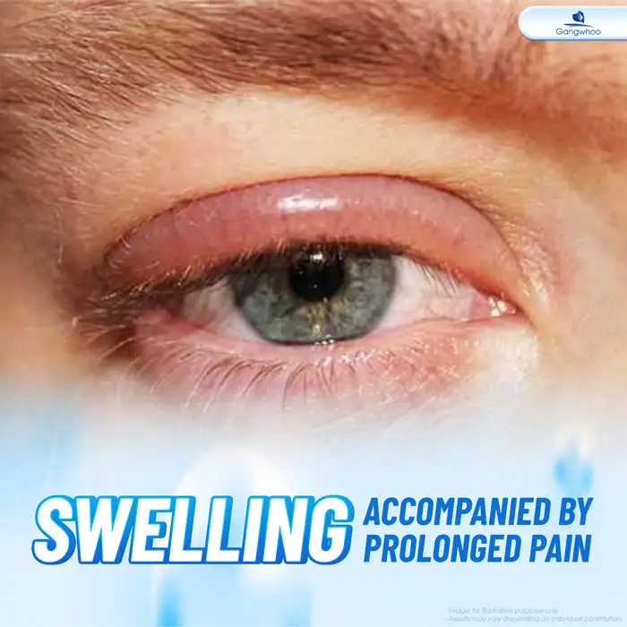 How long does eyelid surgery swelling last? What are effective ways to reduce swelling?