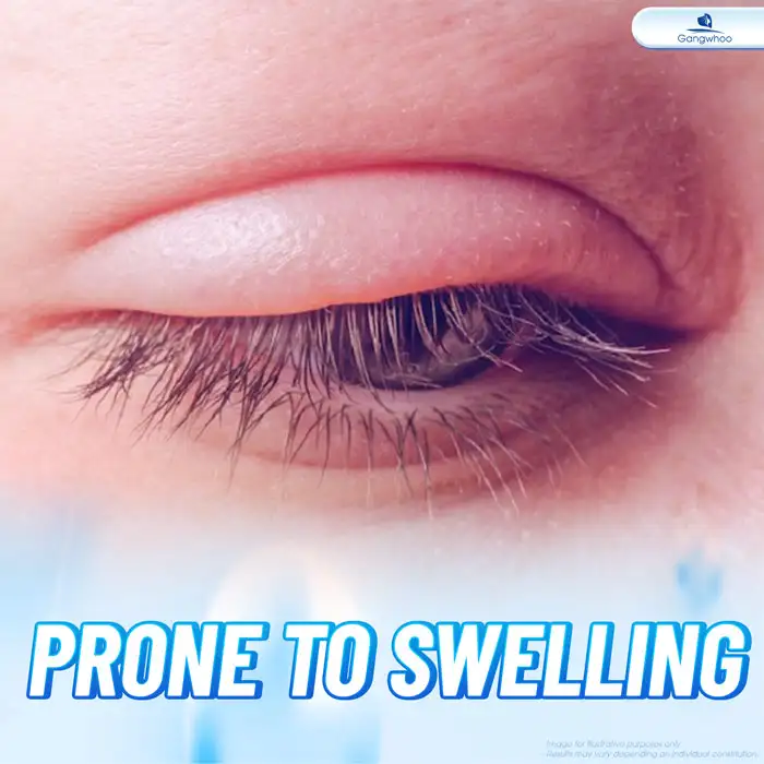 How long does eyelid surgery swelling last? What are effective ways to reduce swelling?