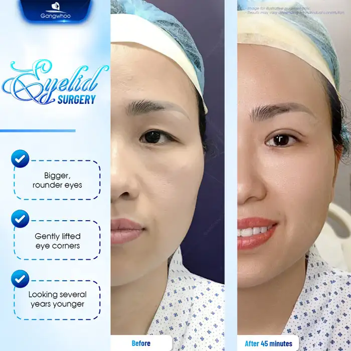 How long after eyelid surgery does eyelid drooping occur? What causes drooping eyelids after eyelid surgery?