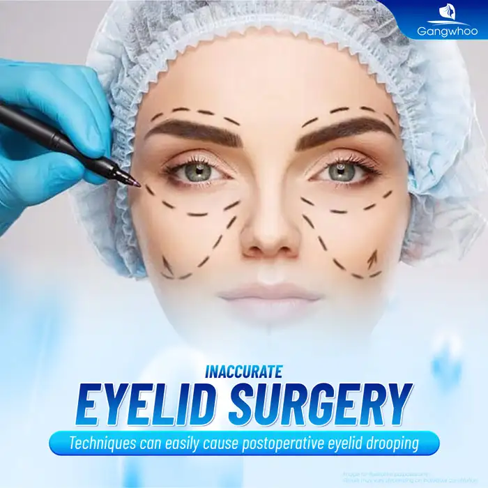 How long after eyelid surgery does eyelid drooping occur? What causes drooping eyelids after eyelid surgery?