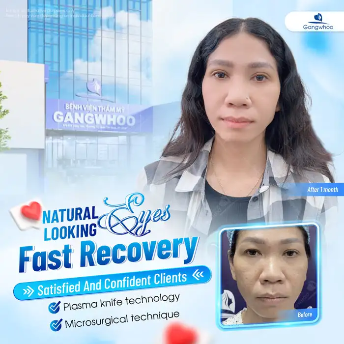 How long after eyelid surgery does eyelid drooping occur? What causes drooping eyelids after eyelid surgery?