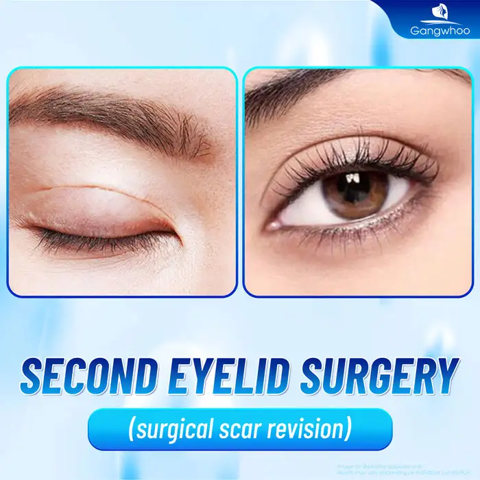 How should hypertrophic scarring after eyelid surgery be treated? What are the causes?