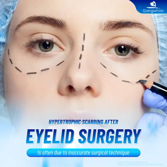 Cắt mí mắt bị sẹo lồi cần xử lý ra sao? Nguyên nhân do đâu?
