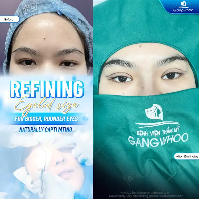 Should Slanted Eyes Undergo Double Eyelid Surgery? Is Double Eyelid Surgery for Slanted Eyes Painful?