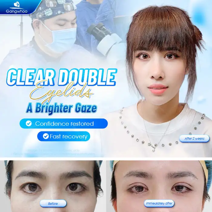 Should Slanted Eyes Undergo Double Eyelid Surgery? Is Double Eyelid Surgery for Slanted Eyes Painful?