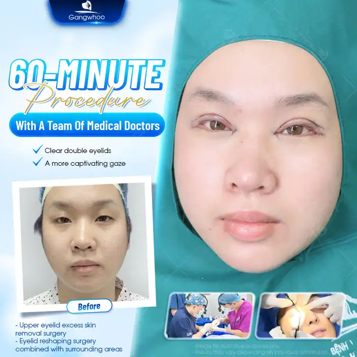 Should Slanted Eyes Undergo Double Eyelid Surgery? Is Double Eyelid Surgery for Slanted Eyes Painful?