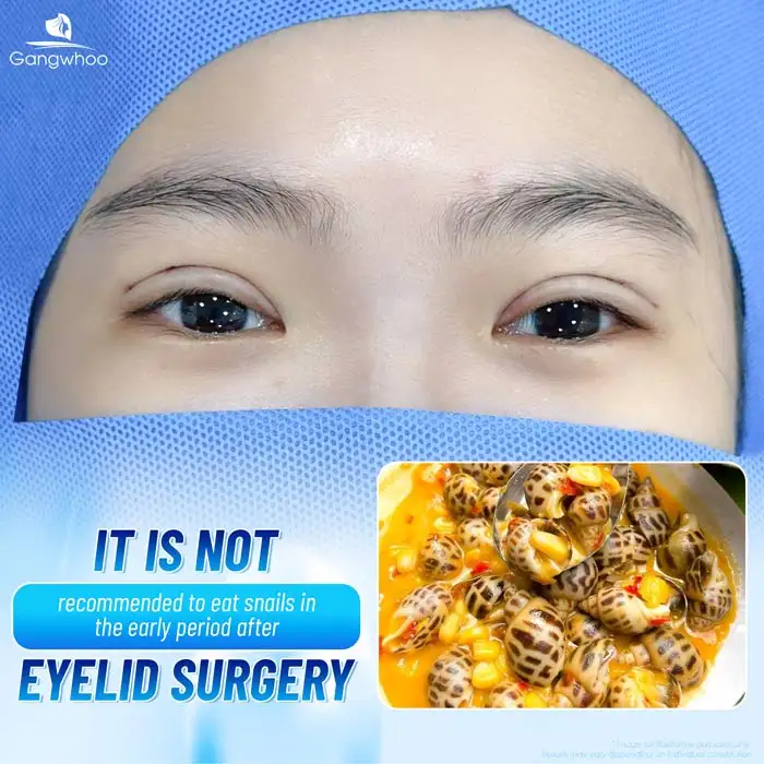 Can You Eat Snails After Double Eyelid Surgery? How Long Should You Avoid Them?