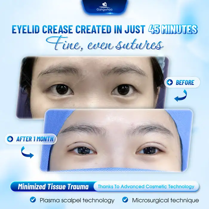 Comparison between full and mini double eyelid surgery: What are the differences?