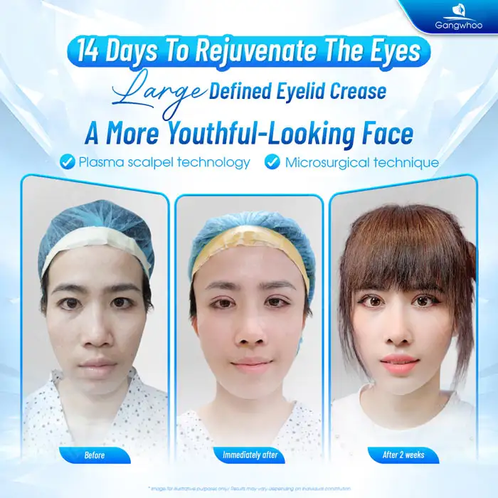 Comparison between full and mini double eyelid surgery: What are the differences?