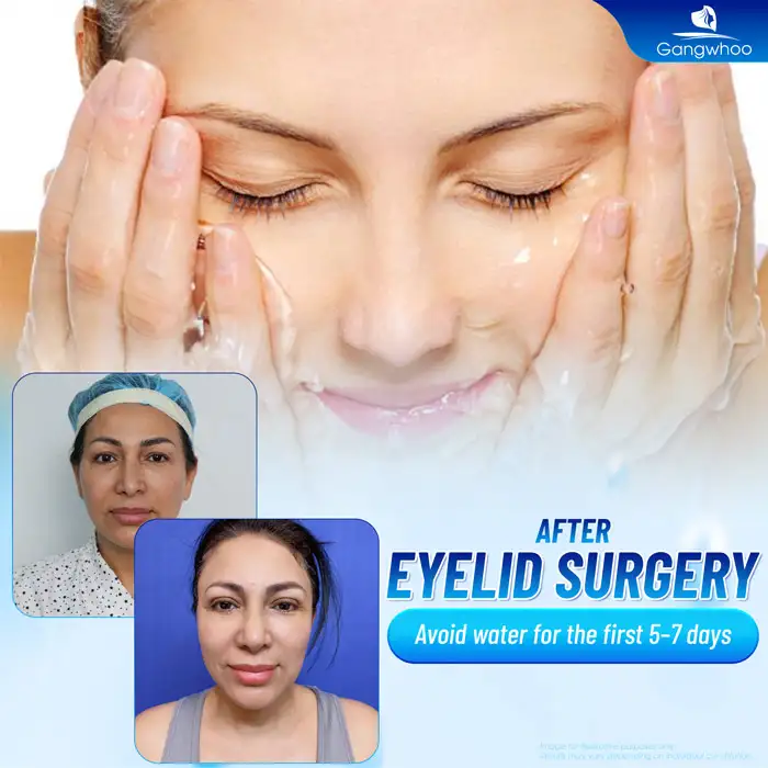 How long should you avoid water after double eyelid surgery? Why is water avoidance necessary after double eyelid surgery?