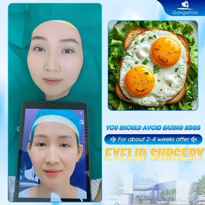 How long should you avoid eggs after double eyelid surgery? When can you eat eggs again?