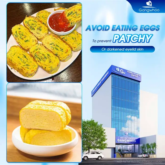 How long should you avoid eggs after double eyelid surgery? When can you eat eggs again?