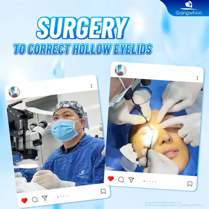 What causes sunken eyelids after double eyelid surgery? Can it be corrected?