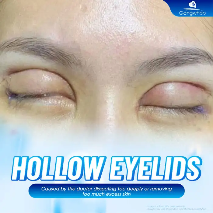 What causes sunken eyelids after double eyelid surgery? Can it be corrected?