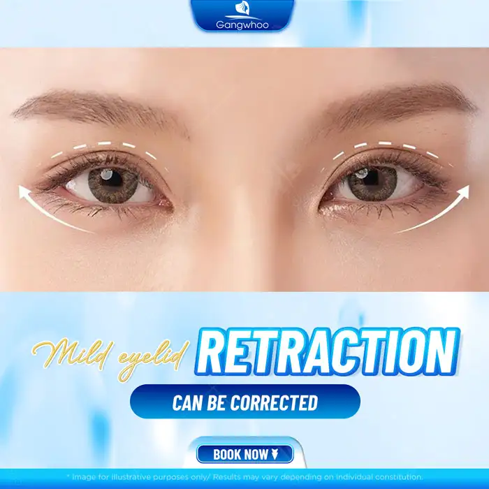 What should be done if the eyes look bulging after double eyelid surgery? Can it be corrected?