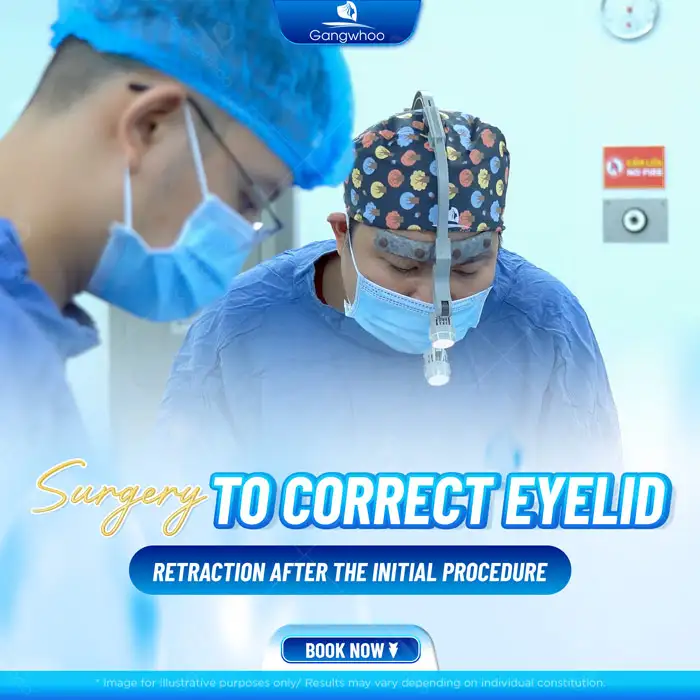 What should be done if the eyes look bulging after double eyelid surgery? Can it be corrected?