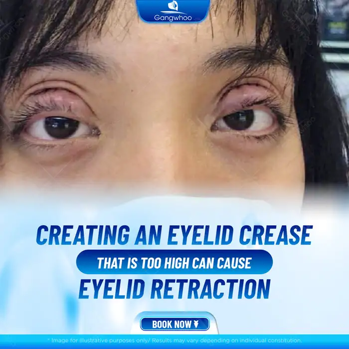What should be done if the eyes look bulging after double eyelid surgery? Can it be corrected?