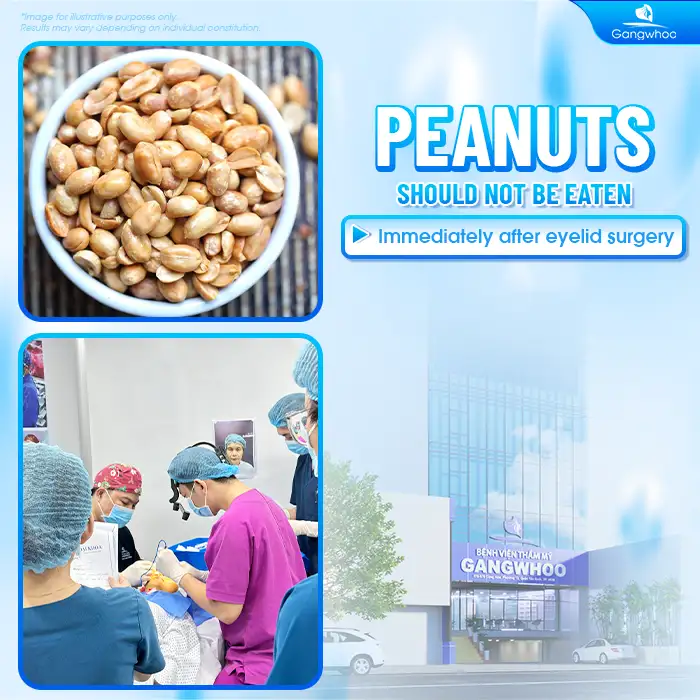 Can you eat peanuts after double eyelid surgery? How long should peanuts be avoided?