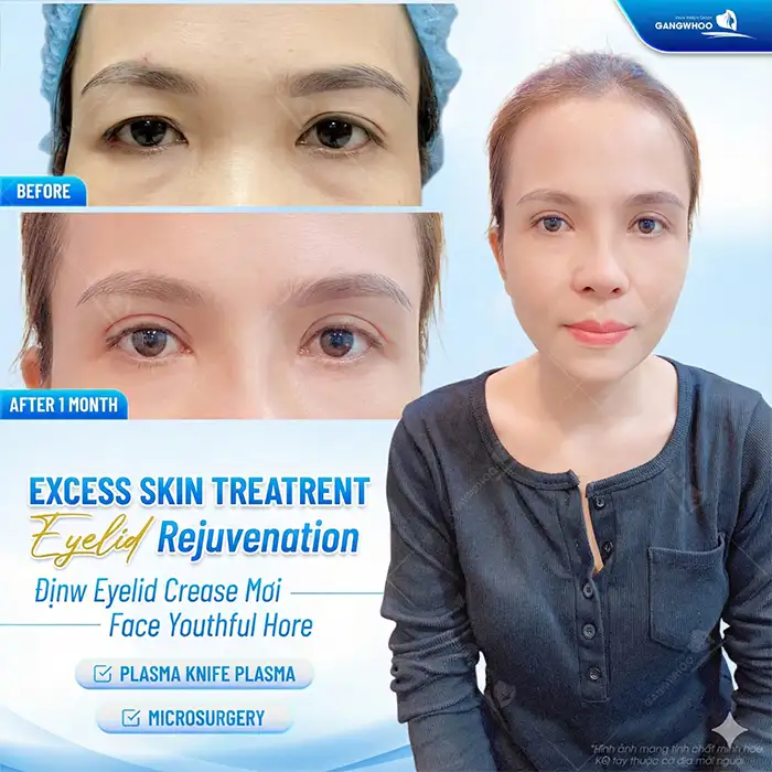 What Are the Non-Surgical Double Eyelid Procedures?