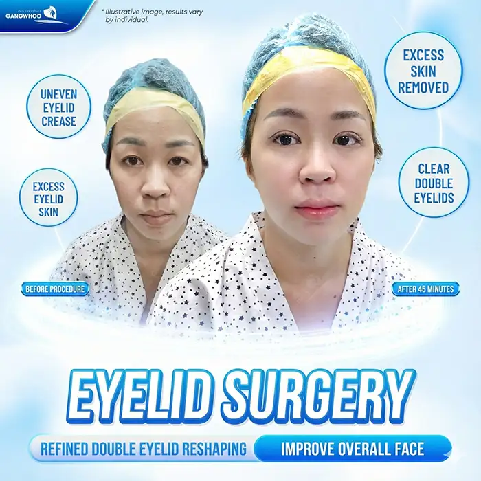 What Are the Non-Surgical Double Eyelid Procedures?