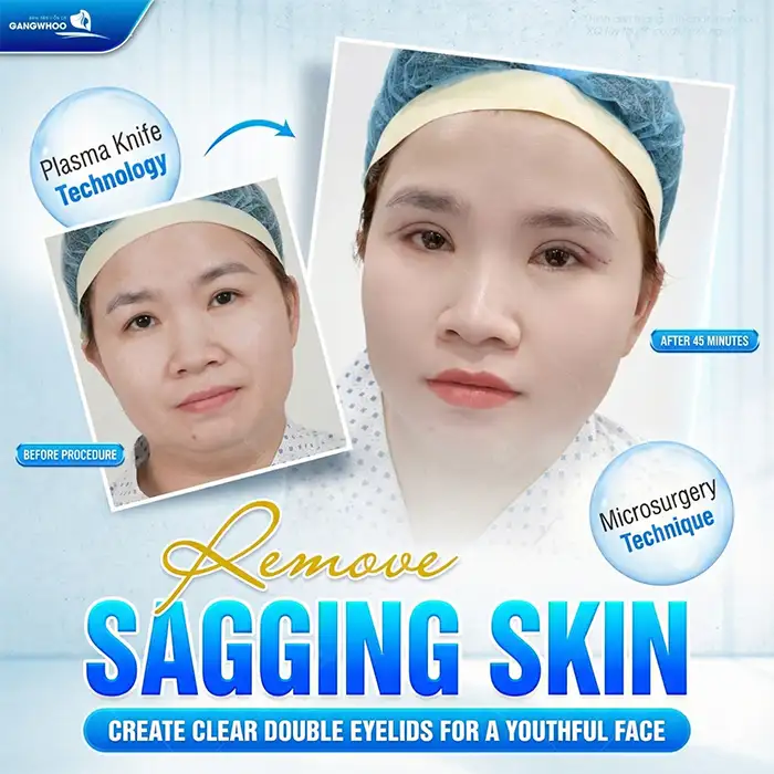 What Are the Non-Surgical Double Eyelid Procedures?