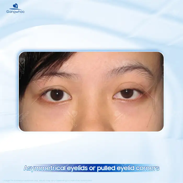 What causes an excessively long blepharoplasty incision? How can it be corrected? 2 What causes an excessively long blepharoplasty incision? How can it be corrected?